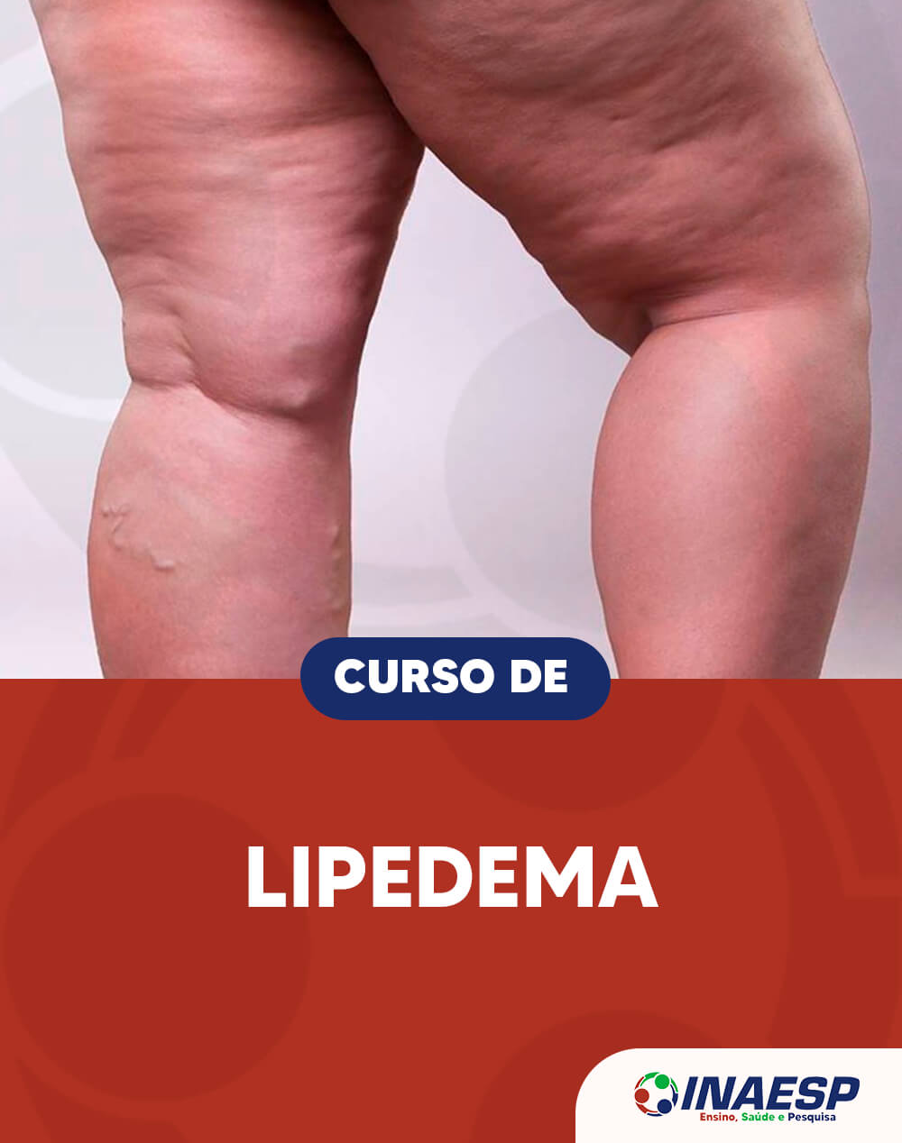 O que é e como tratar Lipedema? - Nutrólogo em Ribeirão Preto