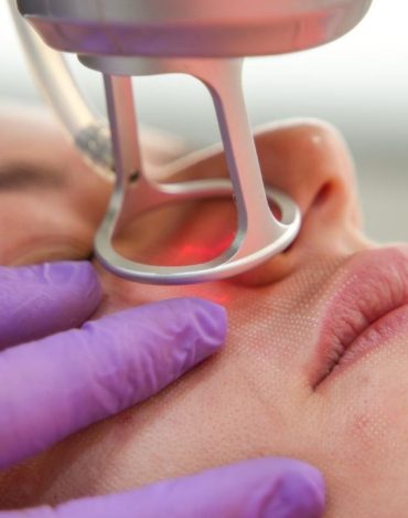 PRÉ VENDA - Curso de Laser CO2 Fracionado