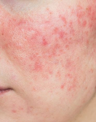 Curso de Rosácea e Peles Sensíveis – Protocolos Combinados